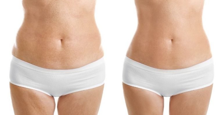Hidrolipoclasia la Liposucción del Futuro