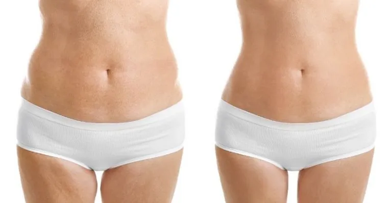 Hidrolipoclasia la Liposucción del Futuro