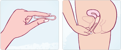 Anillo vaginal anticonceptivo