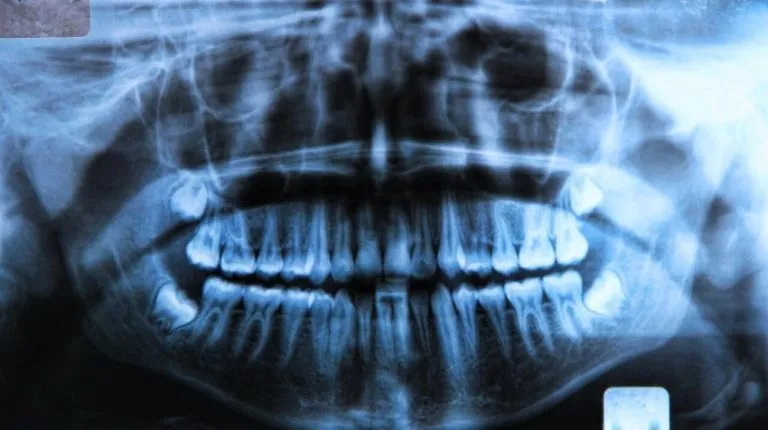 Bifosfonatos y Osteonecrosis de la mandíbula