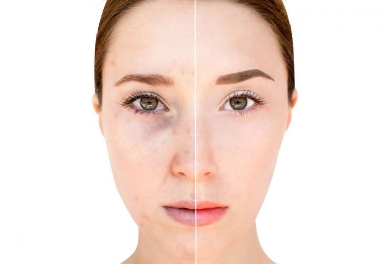 Dermapen