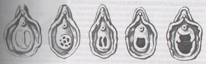 Himen 3 tipos de himen