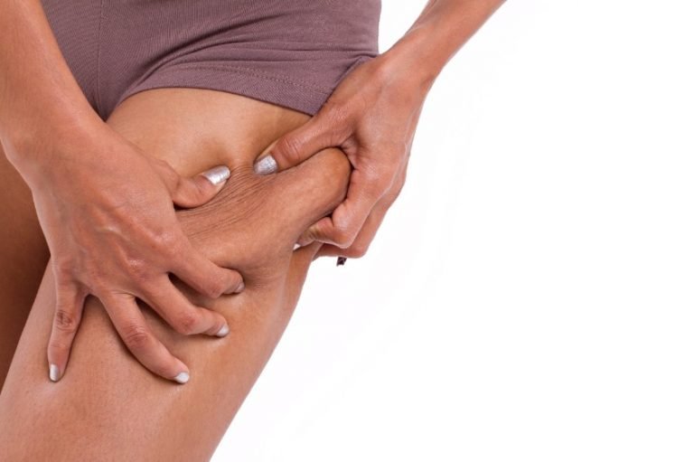 Velashape: ¿Cómo funciona este eficaz tratamiento?