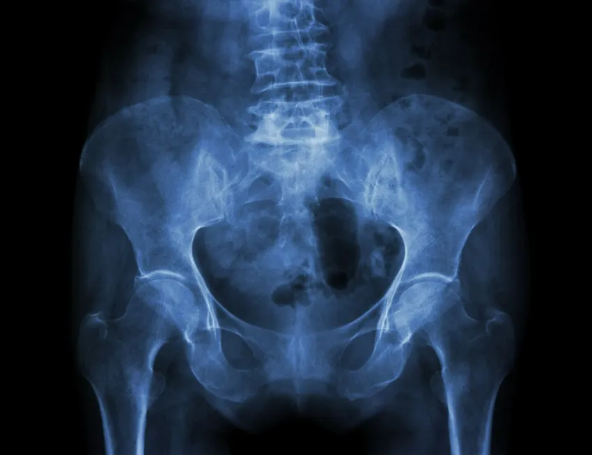 osteoporosis