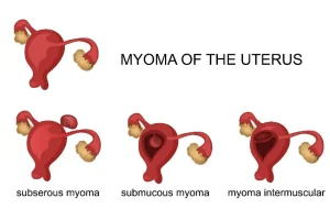 miomatosis uterina
