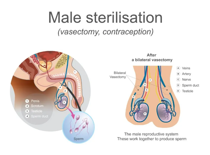 vasectomia
